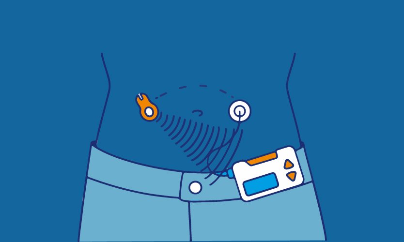 The world’s first artificial pancreas